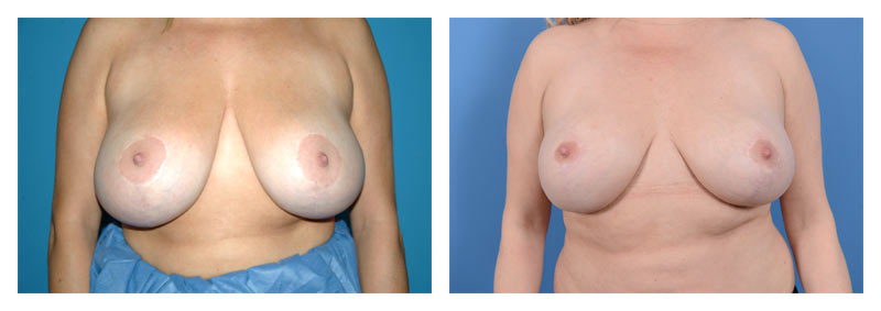 Breast reduction gallery