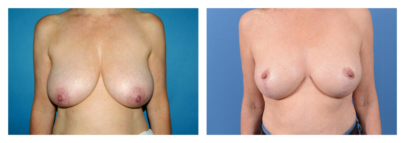 Breast reduction gallery