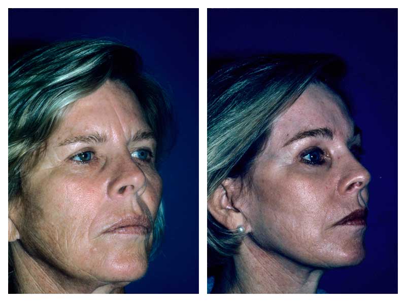 Laser Facial Resurfacing Gallery
