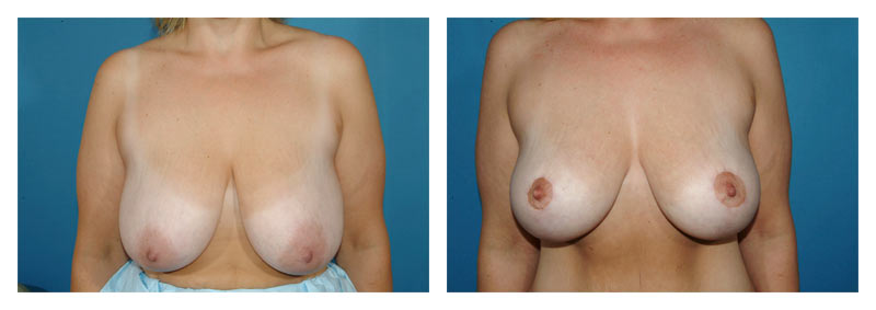 Breast Lift Without Implants