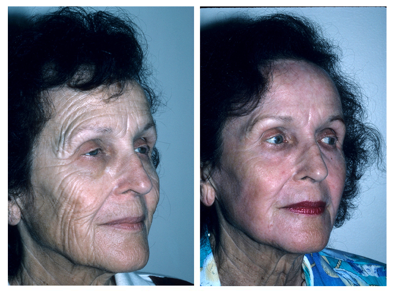Laser Facial Resurfacing Gallery