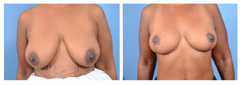 Breast Lift Without Implants